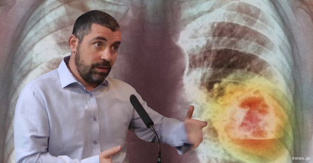 ებრაელი ექიმი გვიყვება როგორ აღმოვაჩინოთ კიბო ადრეულ სტადიაზე, ამით სიცოცხლეს გადაარჩენენ