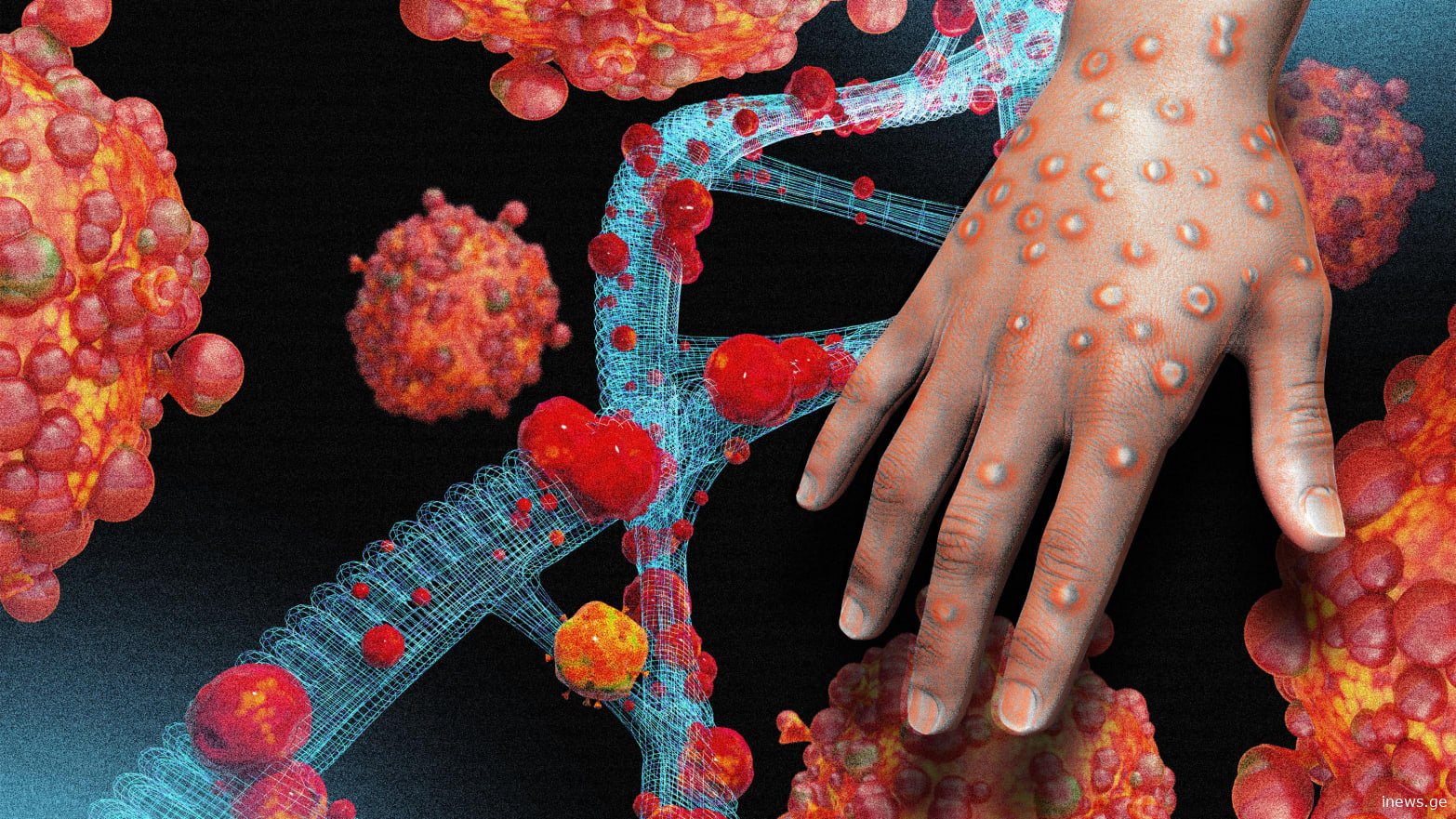 მაიმუნის ჩუტყვავილის გავრცელების გამო აფრიკაში სანგაგებო ვითარებაა - რა ელის მსოფლიოს