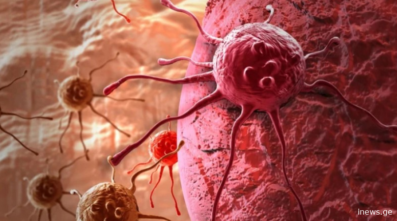 ექიმებმა „ჩუმი“ კიბოს მოულოდნელი სიმპტომი დაასახელეს