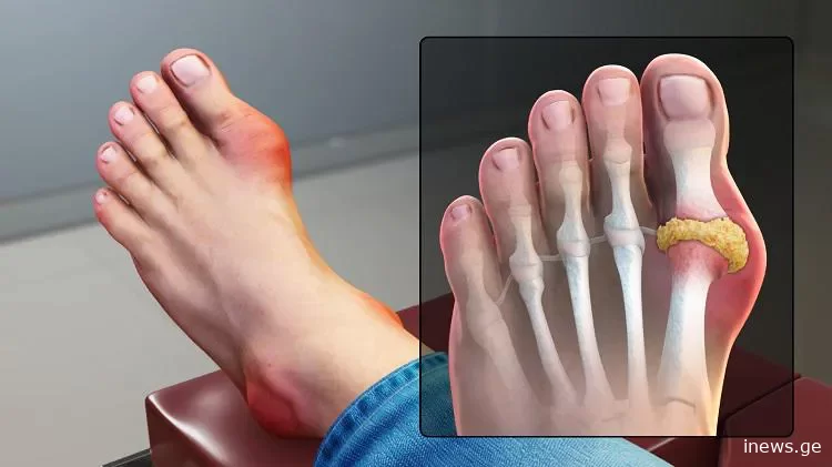 რატომ ჩნდება პოდაგრა? - ახალმა კვლევამ გასაოცარ მიზეზებს მიაკვლია: “ეს ის არ არის, რაც აქამდე გვეგონა“