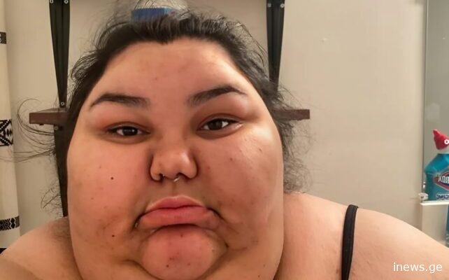 ეს ქალი იწონიდა 200 კილოგრამზე მეტს და შეუსვენებლად ჭამდა როგორ გამოიყურება ეს ქალი დრამატული წონის კლების შემდეგ?